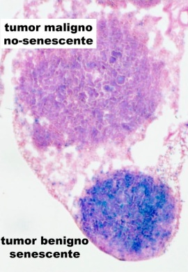 Tumores experimentales en pulmón de ratón mostrando tinción de células senescentes. La tinción es positiva (azul) en los tumores benignos y negativa en los malignos. 